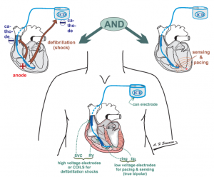 Cardioverter Defibrillator